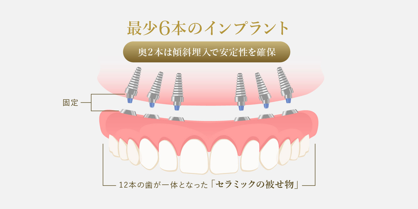 オールオン6の実績と仕組み