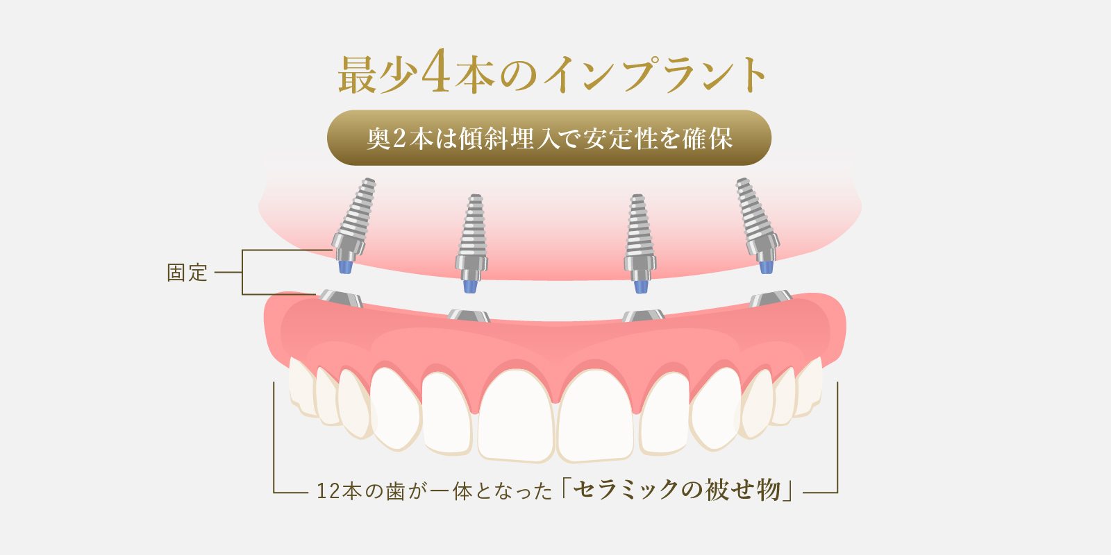 オールオン4の構造と仕組み