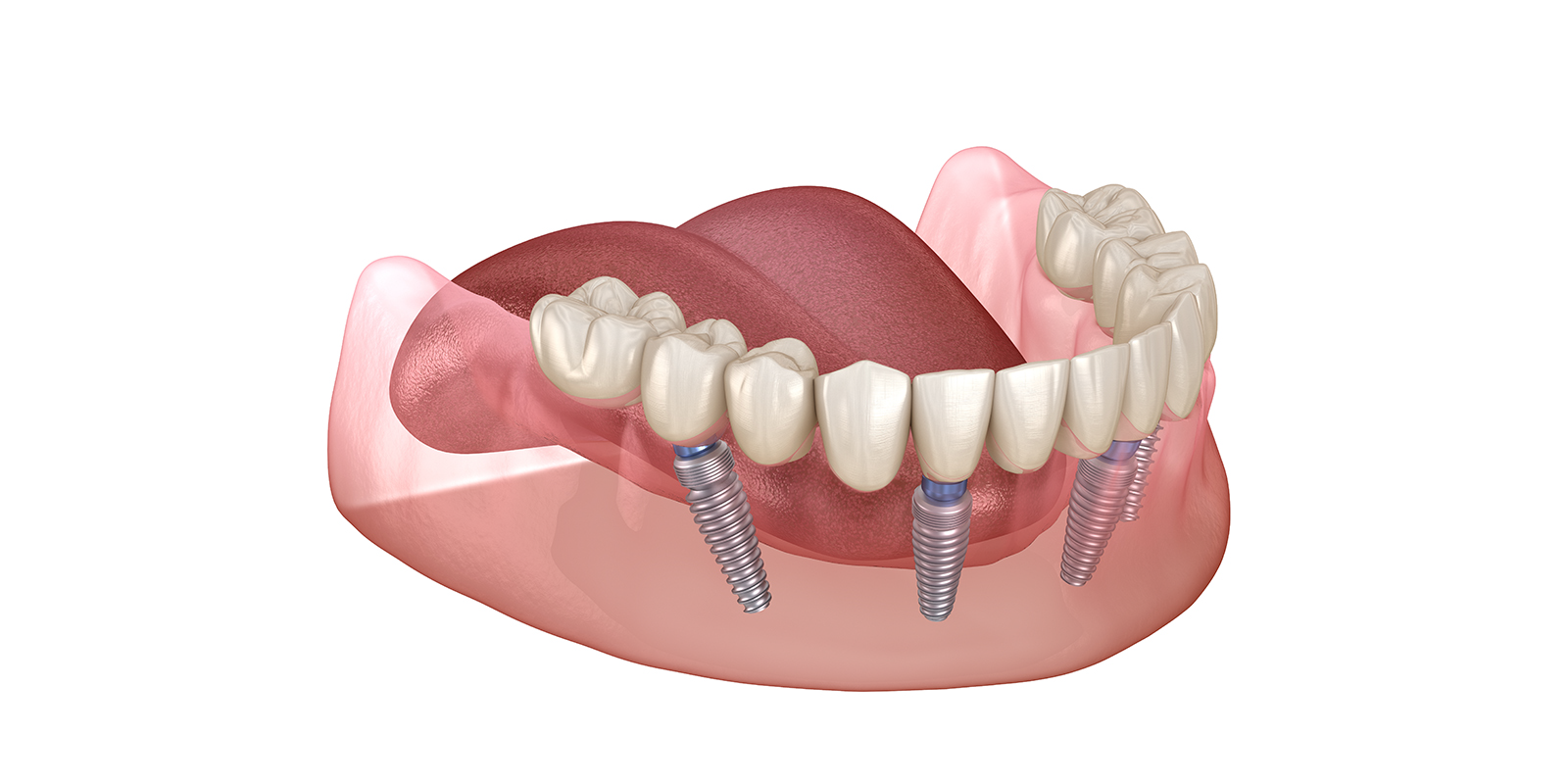 オールオン4のメリット