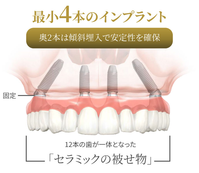 オールオン4の実績と仕組み