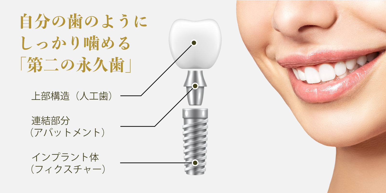 インプラントとは？