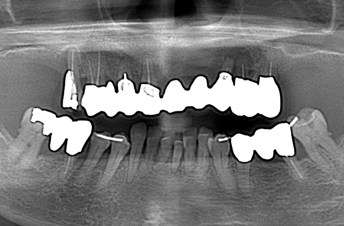 口腔内写真6