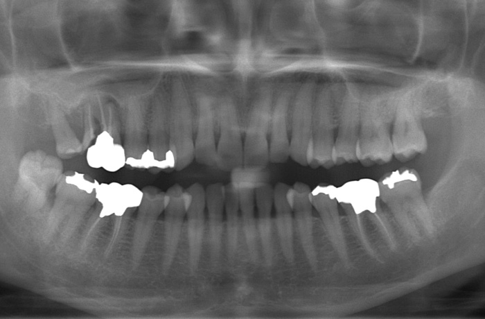 口腔内写真6